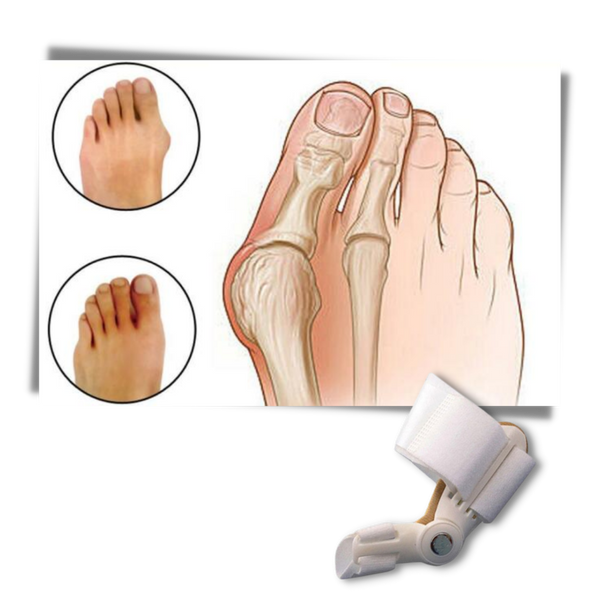 Bunion Corrector Orthotic For Toe Alignment And Pain Relief