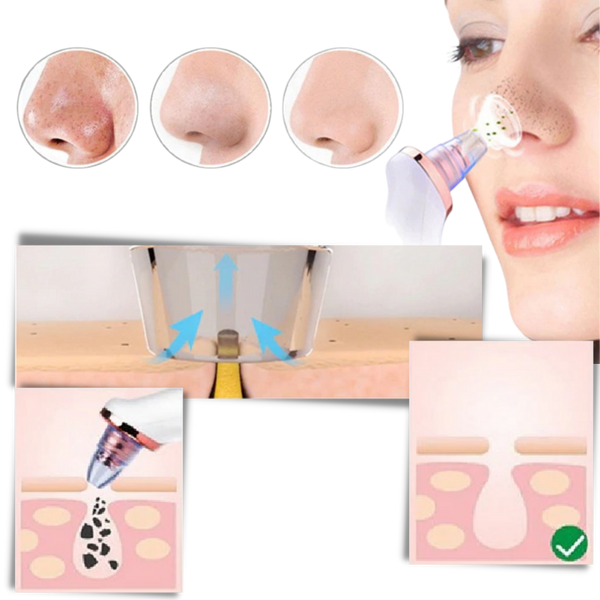 Pore Vacuum For Blackhead Removal And Clearer Smoother Skin