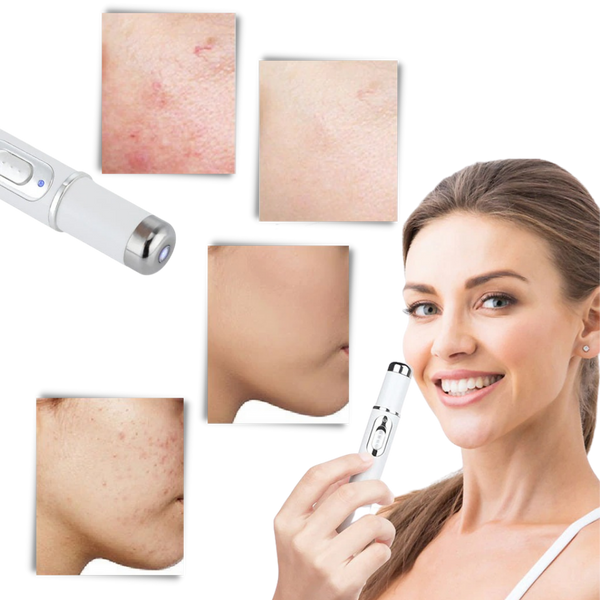 Blue Light Therapy Pen For Varicose And Spider Vein Reduction