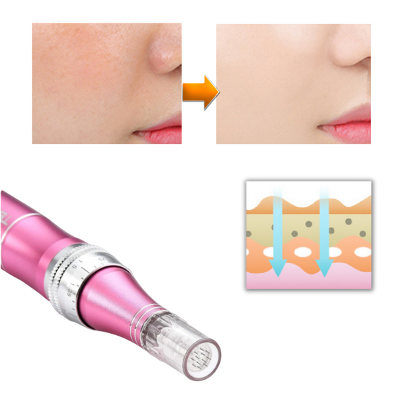 Precision Microneedling Pen For Acne Scar Reduction And Radiant Skin