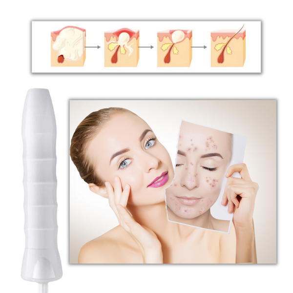 High Frequency Skin Rejuvenation Device For Anti Ageing Glow