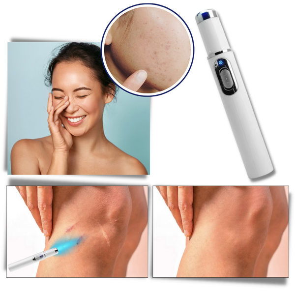 Blue Laser Pen for Dark Spots and Hyperpigmentation Reduction
