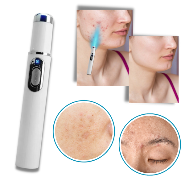 Blue Laser Pen for Dark Spots and Hyperpigmentation Reduction