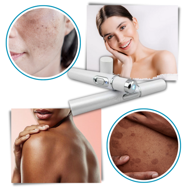 Blue Laser Pen for Dark Spots and Hyperpigmentation Reduction