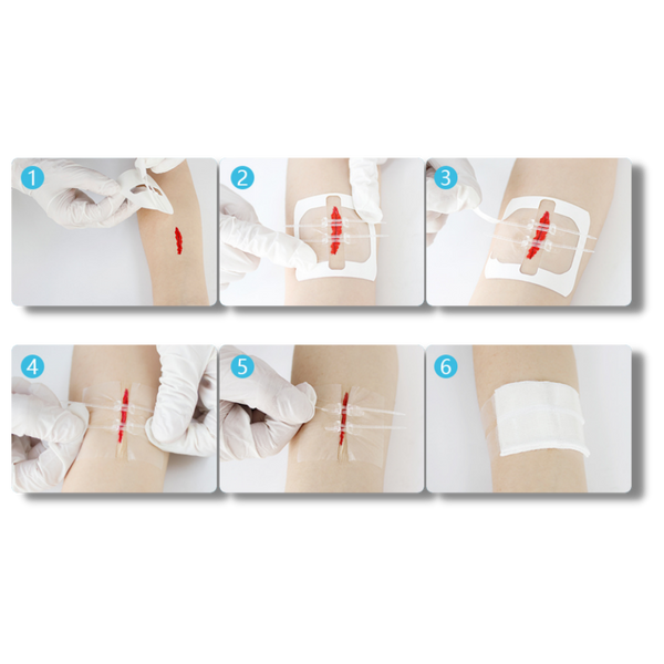 Waterproof Wound Adhesive Patch For Quick Hemostasis And Secure Seal