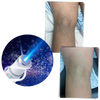 Blue Light Therapy Pen For Varicose And Spider Vein Reduction