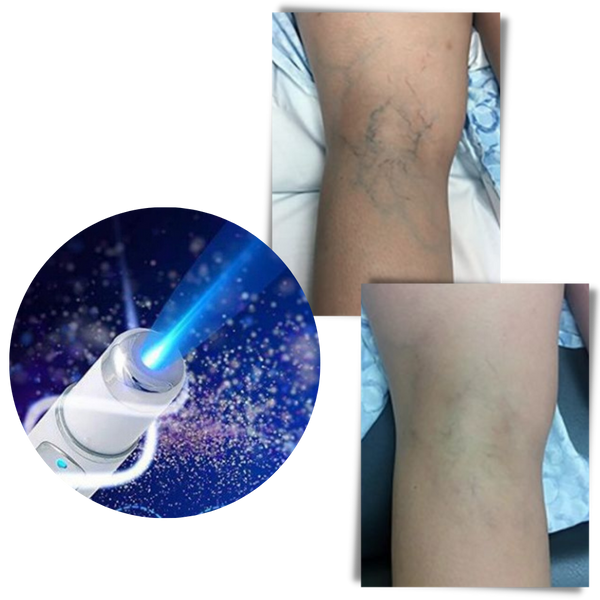 Blue Light Therapy Pen For Varicose And Spider Vein Reduction