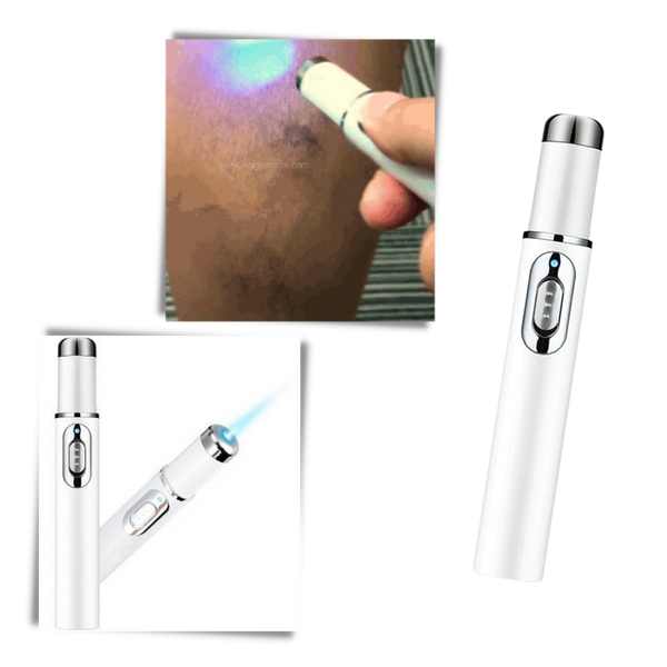 Blue Light Therapy Pen For Varicose And Spider Vein Reduction
