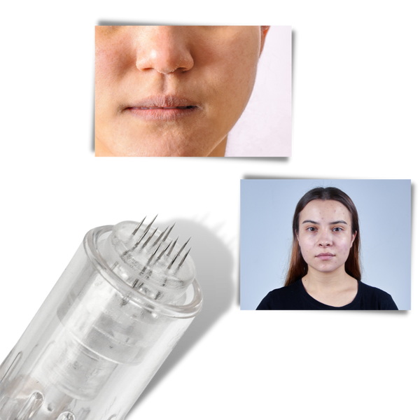 Precision Microneedling Pen For Acne Scar Reduction And Radiant Skin