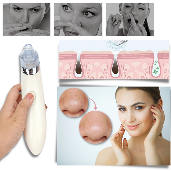 Premium Gentle Facial Blackhead Removal Kit For Sensitive Skin