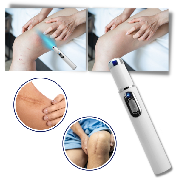 Blue Laser Pen for Dark Spots and Hyperpigmentation Reduction