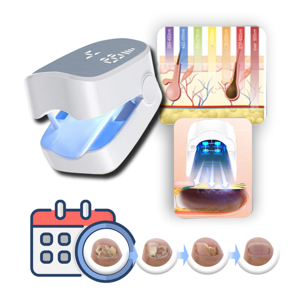 Painless Nail Fungus Laser Therapy for Healthier Nails at Home