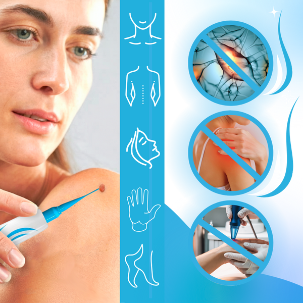 Gentle Skin Tag Eliminator Device Pain Free At Home Treatment