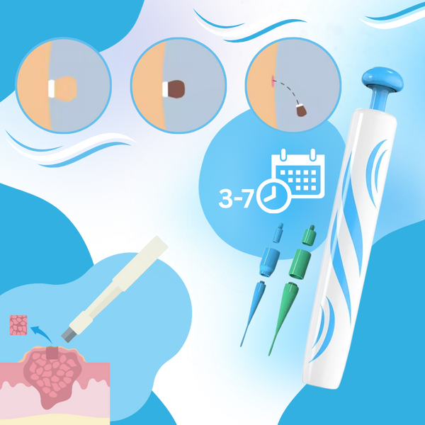 Gentle Skin Tag Eliminator Device Pain Free At Home Treatment