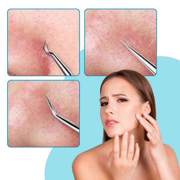 Multifunctional Precision Pointed Tweezers Set For Flawless Skin